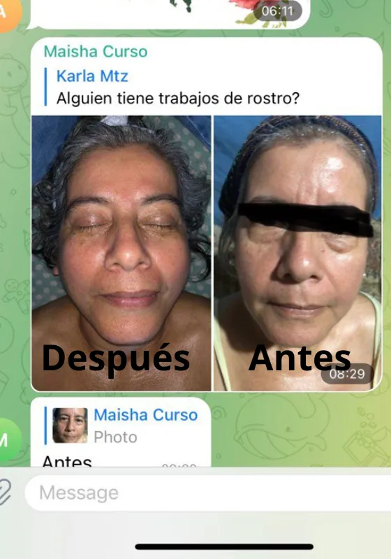 Rejuvenecimiento facial antes y después