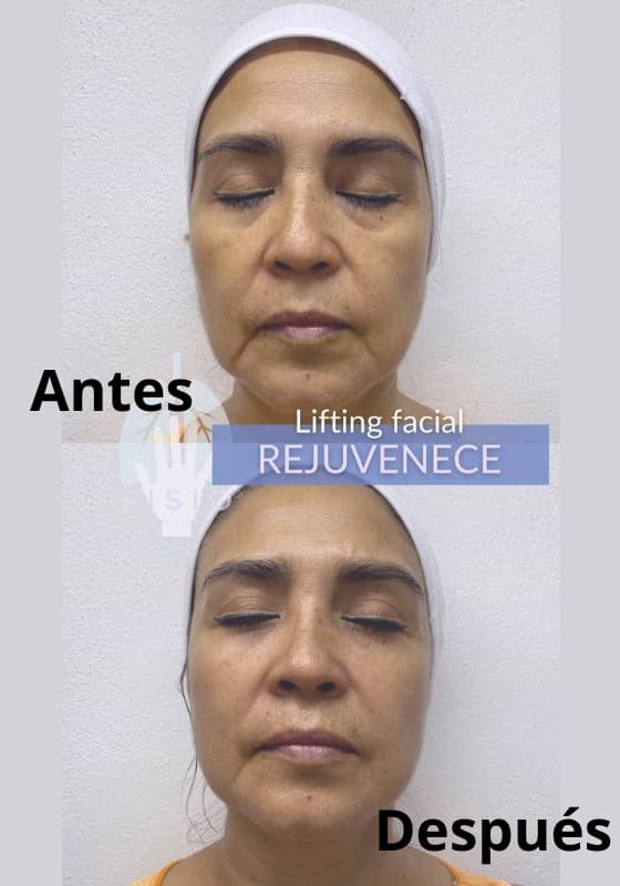 Rejuvenecimiento facial testimonios